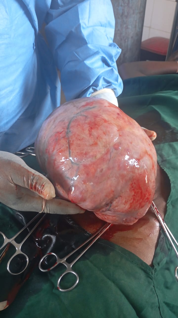 Surgical team conducting fibroid operation (myomectomy)