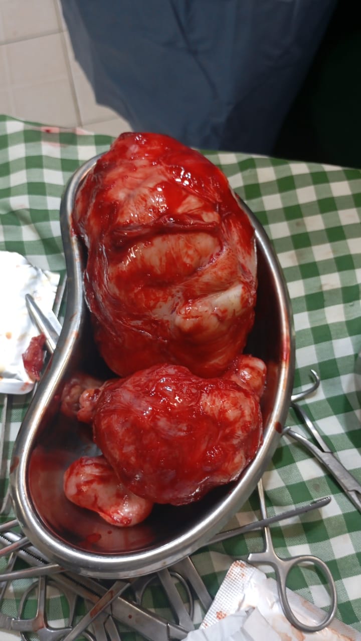 Fibroids extracted during successful myomectomy procedure